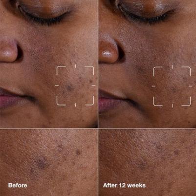 Еще лучшая клиническая сыворотка от темных пятен с витамином С – фото 2