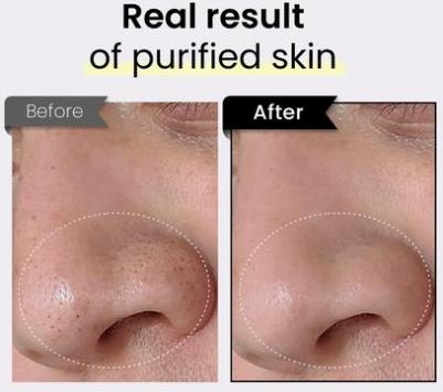 Маска для очищения пор Black Rice Txa с транексамовой кислотой 3-в-1 Детокс-сыворотка – фото 3