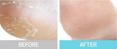 Комплект пилинг-масок для пяток Exfoliating Heel Mask, 2*18 г – фото 2