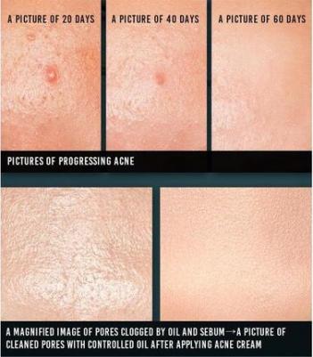 ACNE, крем, 50 мл (1,69 жидк. унции) – фото 2