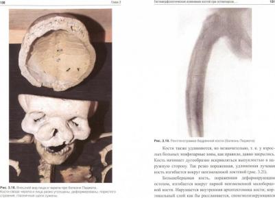 Осипенкова-Вичтомова Тамара Константиновна. Судебно-медицинская экспертиза костей – фото 1